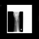 Rhizarthrosis, mediocalcinosis: X-ray - Plain radiograph